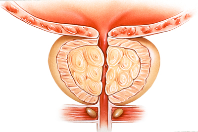 Prostatectomy Image